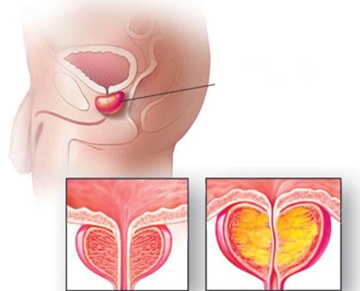 Prostatos liaukos vieta, normali prostata ir padidėjusi sergant lėtiniu prostatitu