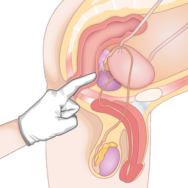 Prostatos būklės nustatymas palpacijos būdu prostatito diagnozei