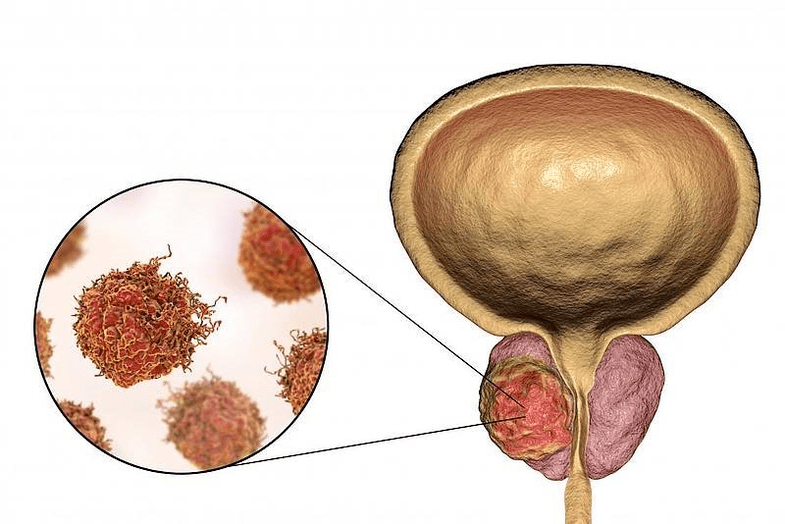 kaip atrodo prostatos pažeidimas