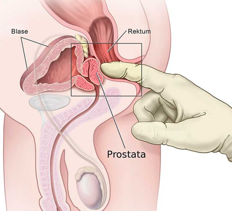 prostatos masažas sergant prostatitu