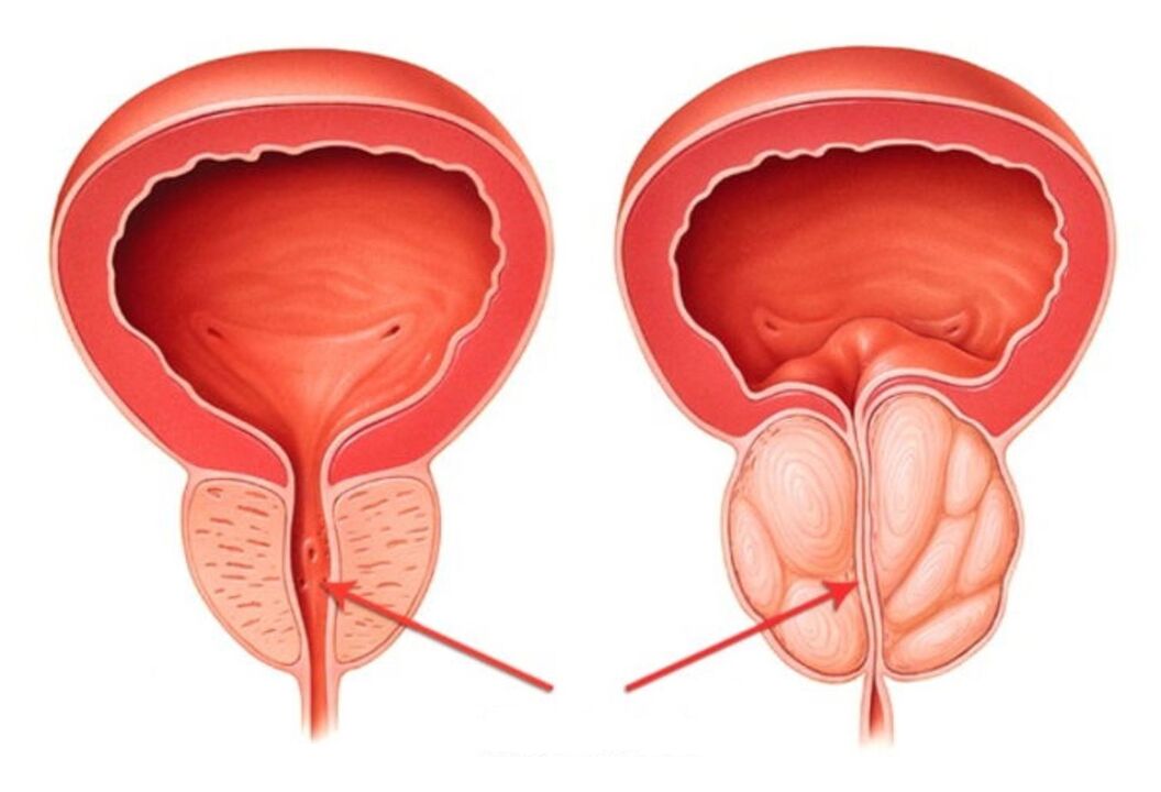 sveika ir uždegusi prostata su prostatitu